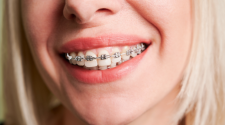 Damon Braces in Dubai | All You Need to Know