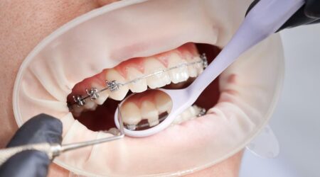 Damon Braces Dubai | An Efficient Way to Straighten Teeth