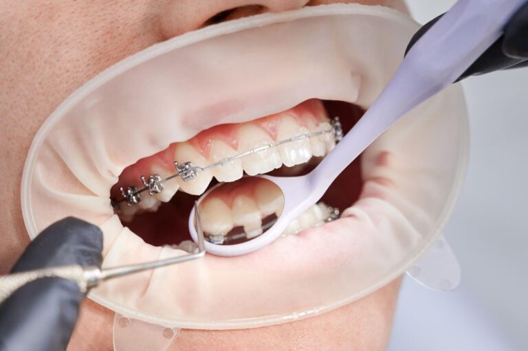Read more about the article Damon Braces Dubai | An Efficient Way to Straighten Teeth