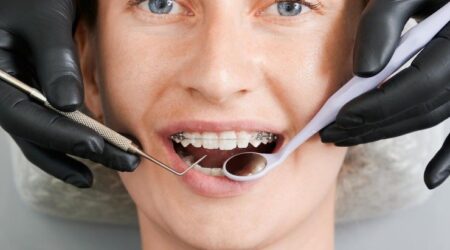 After Dental Braces | Do I Need Permanent Retainers?