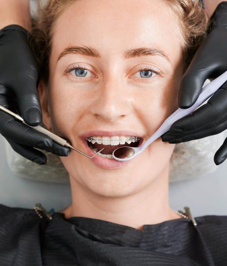Read more about the article After Dental Braces | Do I Need Permanent Retainers?