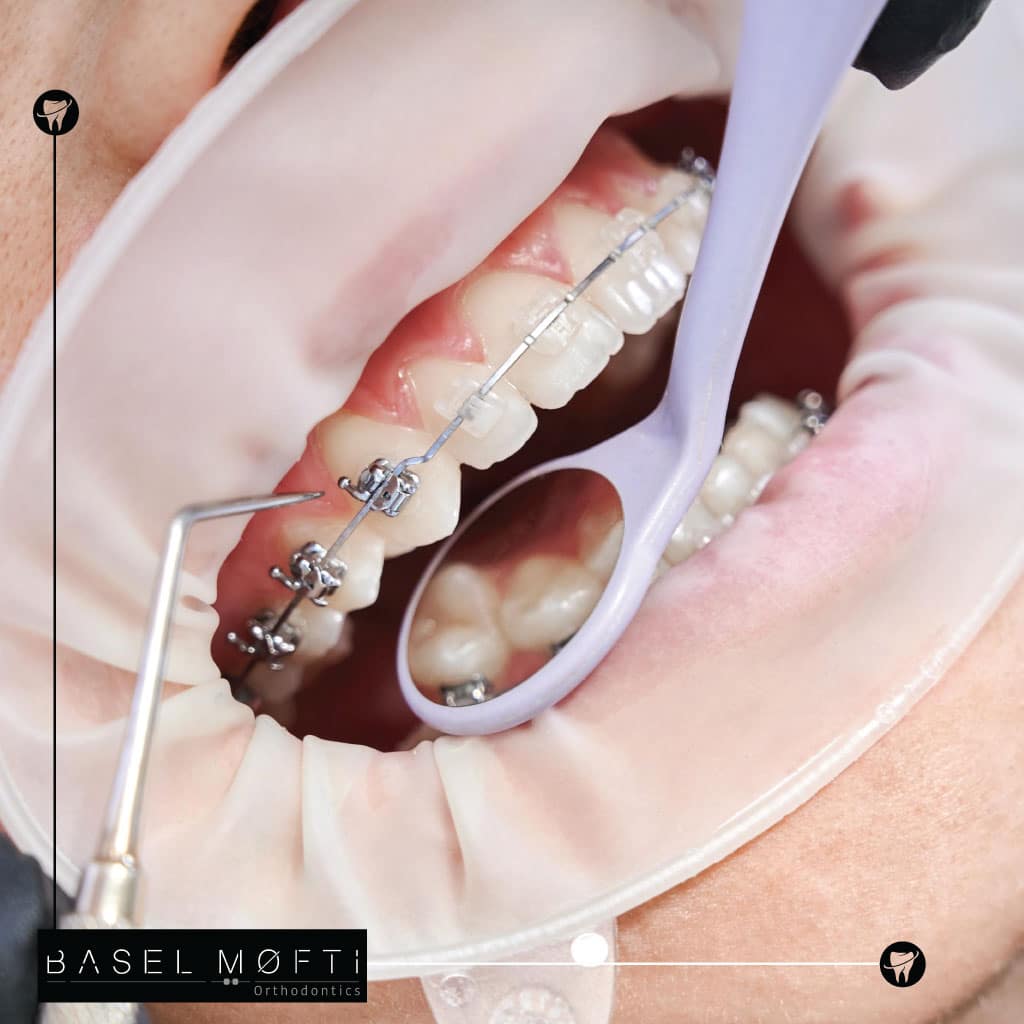 Damon Braces Treatment Dubai