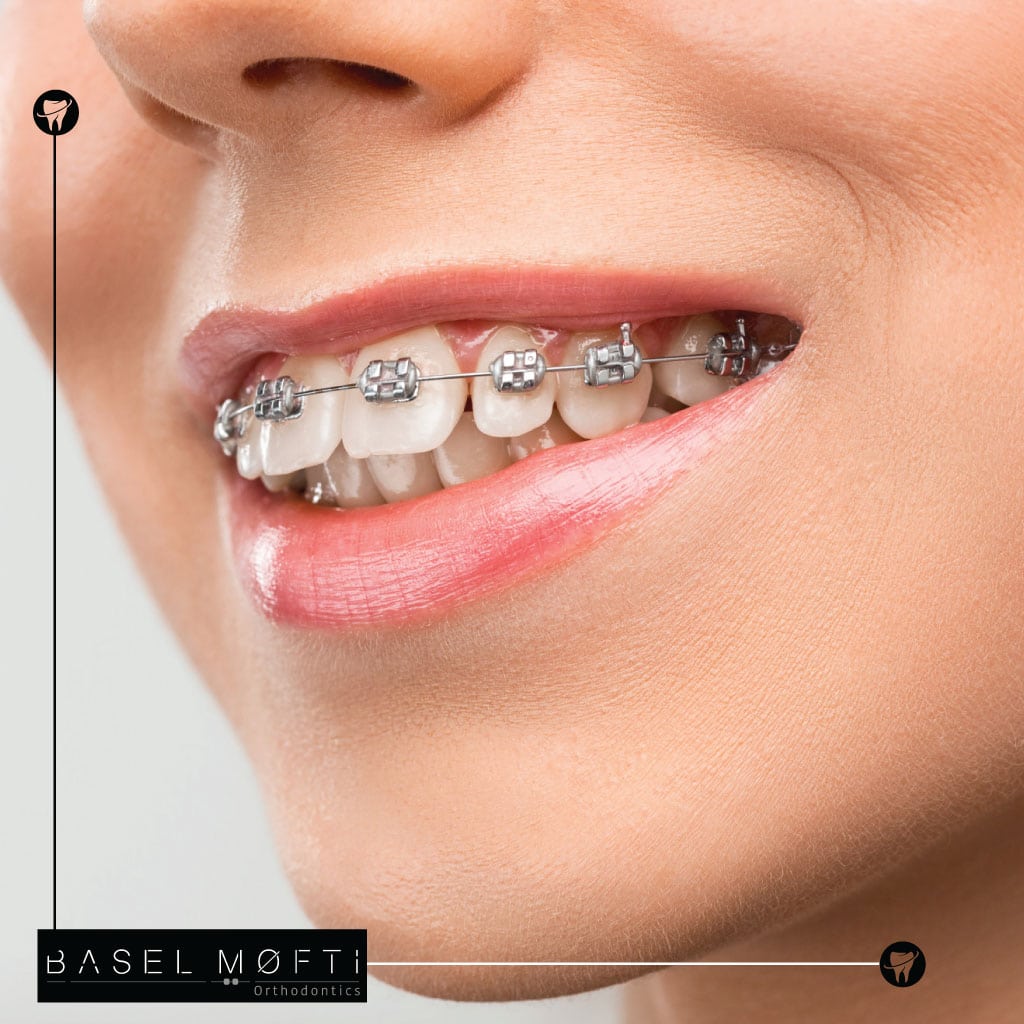 Traditional Metal Braces