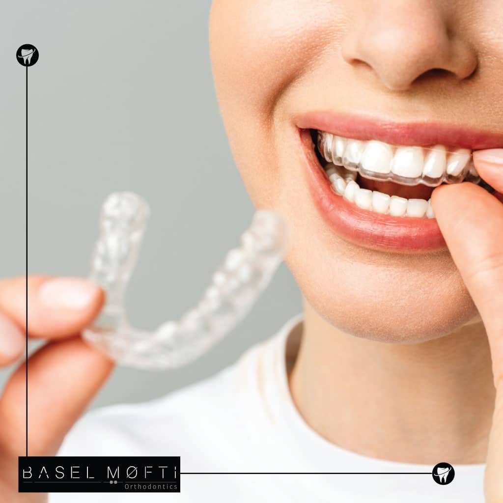 Invisalign and Clear Aligners Work
