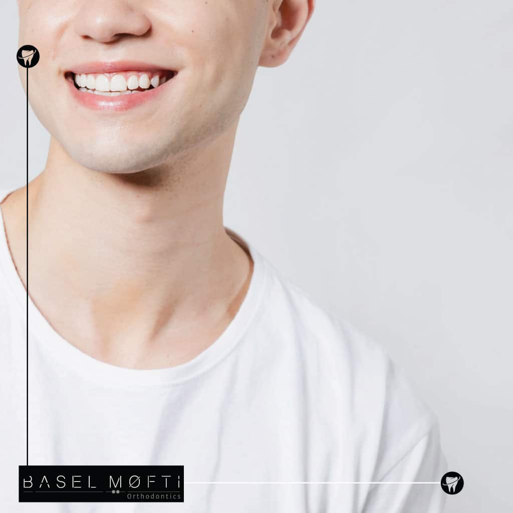 Lingual Braces, also known as Incognito Hidden Braces treatment