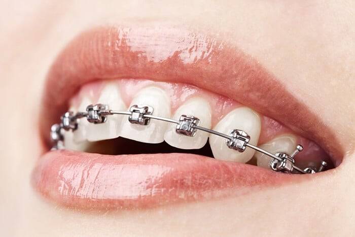 Damon Braces in orthodontic clinic in Dubai, United Arab of Emirates