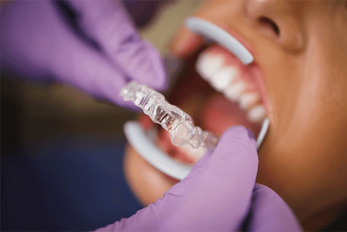 Invisalign Braces within our orthodontic clinic in Dubai, UAE