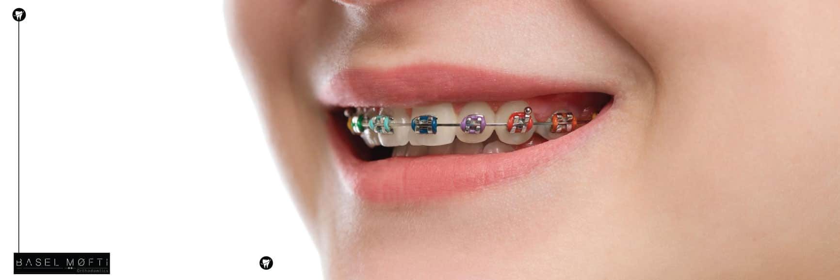 Damon-Braces-By-Basel-Mofti-Orthodontist-Dubai