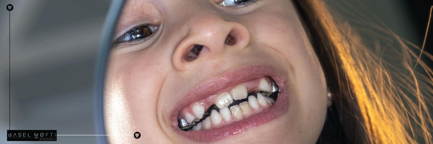 Early Intervention for Lifelong Smiles: Dr. Basel Mofti's Expert Orthodontic Care