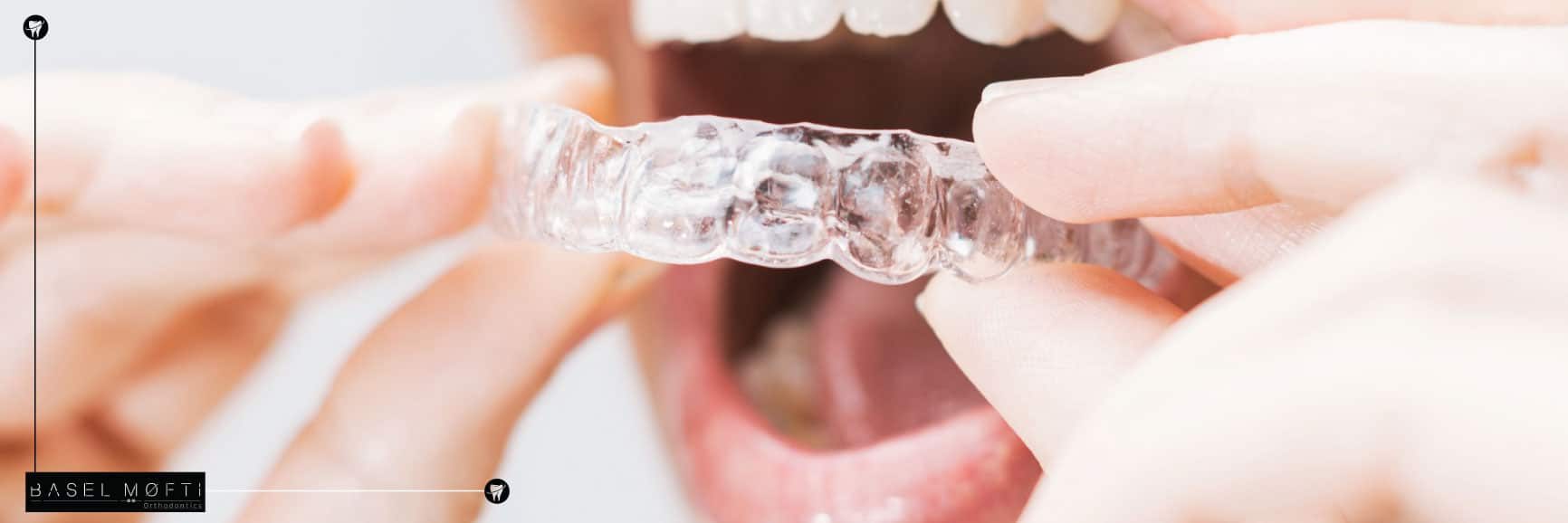 Invisalign and Clear Aligners in Dubai