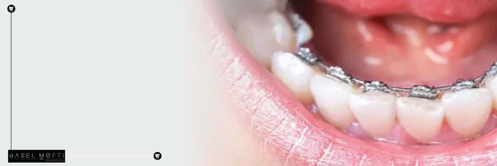 Lingual Braces in Dubai